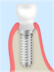 インプラント治療とは