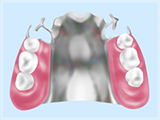 金属床（ゴールド、チタン、コバルトクロム）義歯（自費）