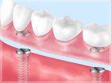 インプラントアタッチメント（自費）