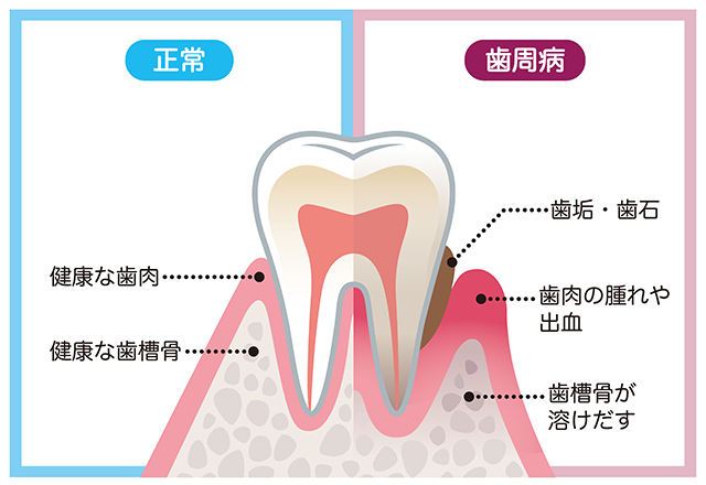 歯周病とは