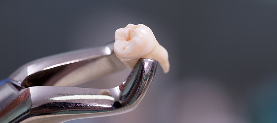 抜歯の重要性について