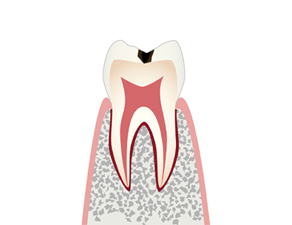 C1【エナメル質の虫歯】