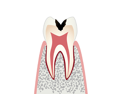 C2【象牙質の虫歯】