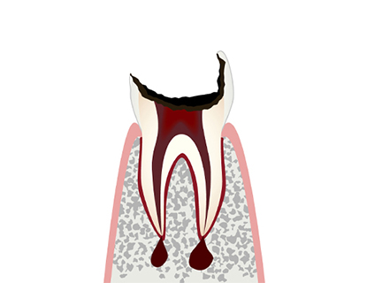 C4【歯根まで達した虫歯】